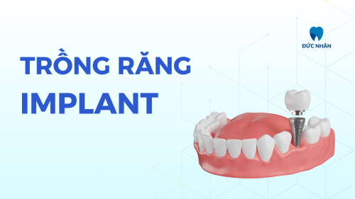 Trồng Răng Implant